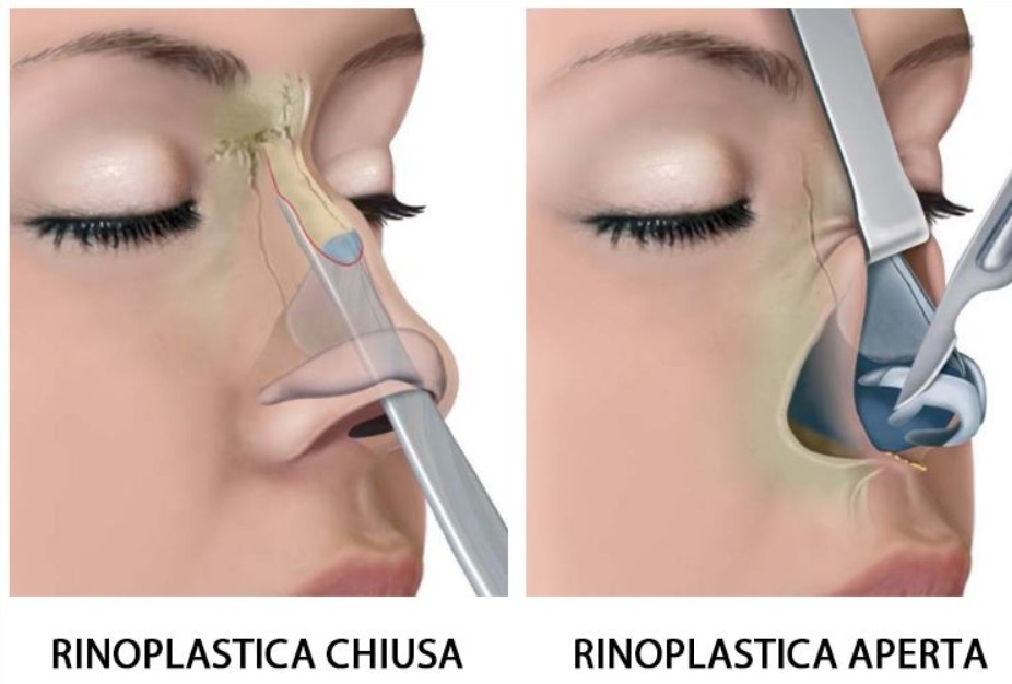 http://lawise.co.uk/rinoplastica-chirurgia-estetica-e-valido-del-naso/